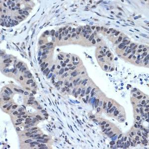 Immunohistochemistry analysis of paraffin-embedded human colon carcinoma tissue using Anti-XPD Antibody [ARC2401] (A305413) at a dilution of 1:100 (40x lens) Perform microwave antigen retrieval with 10 mM Tris/EDTA buffer pH 90 before commencing with IHC staining protocol