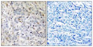 Immunohistochemical analysis of paraffin-embedded human breast carcinoma tissue using Anti-PDIK1L Antibody The right hand panel represents a negative control, where the antibody was pre-incubated with the immunising peptide