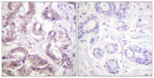 Immunohistochemical analysis of paraffin-embedded human breast carcinoma tissue using Anti-Survivin Antibody. The right hand panel represents a negative control, where the Antibody was pre-incubated with the immunising peptide