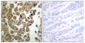 Immunohistochemical analysis of paraffin-embedded human breast carcinoma using Anti-PKC delta (phospho Thr505) Antibody. The right hand panel represents a negative control, where the antibody was pre-incubated with the immunising peptide