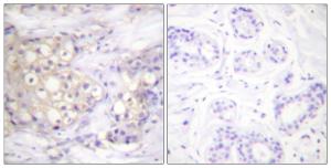 Immunohistochemical analysis of paraffin-embedded human breast carcinoma using Anti-PKC alpha (phospho Thr638) Antibody. The right hand panel represents a negative control, where the antibody was pre-incubated with the immunising peptide.