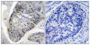 Immunohistochemical analysis of paraffin-embedded human colon carcinoma using Anti-Histone H1 (phospho Thr17) Antibody. The right hand panel represents a negative control, where the antibody was pre-incubated with the immunising peptide