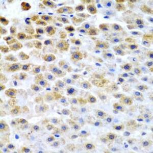 Immunohistochemistry analysis of paraffin-embedded human liver cancer using Anti-TFPI2 Antibody (A9817) at a dilution of 1:200 (40X lens). Perform microwave antigen retrieval with 10 mM PBS buffer pH 7.2 before commencing with IHC staining protocol