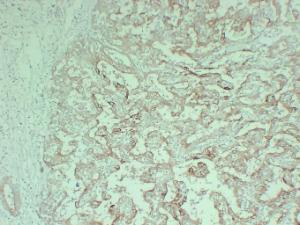 Immunohistochemical analysis of paraffin-embedded human Cholangiocarcinoma using Anti-Cytokeratin 18 Antibody