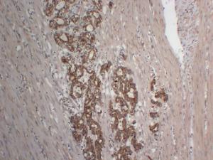 Immunohistochemical analysis of paraffin-embedded human gastric adenocarcinoma using Anti-Cytokeratin 18 Antibody