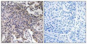 Immunohistochemical analysis of paraffin-embedded human lung carcinoma tissue using Anti-MRPL54 Antibody. The right hand panel represents a negative control, where the antibody was pre-incubated with the immunising peptide.