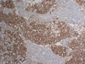 Immunohistochemical analysis of paraffin-embedded human Hepatocellular carcinoma using Anti-Cytokeratin 18 Antibody