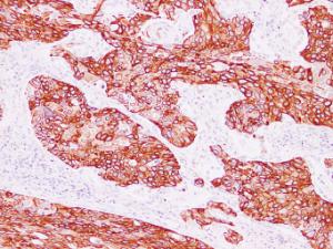 Immunohistochemical analysis of paraffin-embedded human Squamous cell lung carcinoma using Anti-Cytokeratin 15 Antibody