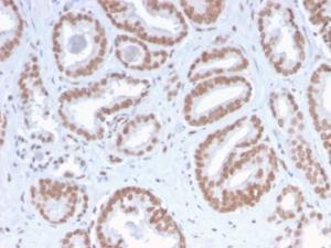 Immunohistochemical analysis of formalin-fixed, paraffin-embedded human prostate carcinoma using Anti-ATRX Antibody [ATRX/2900R]