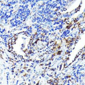 Immunohistochemistry analysis of paraffin-embedded human lung cancer using Anti-CD9 Antibody [ARC0330] (A309237) at a dilution of 1:100 (40X lens). Perform microwave antigen retrieval with 10 mM PBS buffer pH 7.2 before commencing with IHC staining protocol