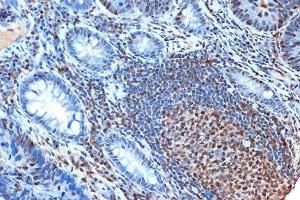 Immunohistochemistry analysis of paraffin-embedded human colon carcinoma tissue using Anti-FEN1 Antibody [ARC1376] (A306332) at a dilution of 1:100 (40X lens). Perform microwave antigen retrieval with 10 mM Tris/EDTA buffer pH 9.0 before commencing with IHC staining protocol