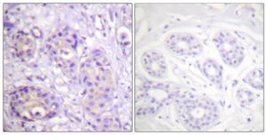 Immunohistochemical analysis of paraffin-embedded human breast carcinoma using Anti-IKK-beta (phospho Tyr199) Antibody. The right hand panel represents a negative control, where the antibody was pre-incubated with the immunising peptide