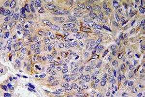 Immunohistochemical analysis of paraffin-embedded human lung carcinoma tissue using Anti-IL-32 Antibody