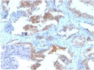 Immunohistochemical analysis of formalin-fixed, paraffin-embedded human prostate tissue using Anti-MIF Antibody [MIF/3489]. Inset: PBS instead of the primary antibody. Secondary antibody negative control