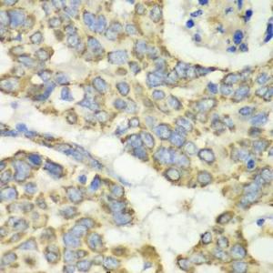 Immunohistochemistry analysis of paraffin-embedded human esophageal cancer using Anti-TUFM Antibody (A9861) at a dilution of 1:100 (40x lens). Perform microwave antigen retrieval with 10 mM PBS buffer pH 7.2 before commencing with IHC staining protocol.