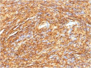 Immunohistochemical analysis of formalin-fixed, paraffin-embedded human GIST using Anti-TMEM16A Antibody [DG1/1484]