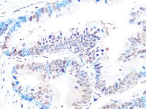 Immunohistochemistry analysis of paraffin-embedded human colon carcinoma tissue using Anti-Casein Kinase 2 beta Antibody [ARC1069] (A309247) at a dilution of 1:100 (40X lens). Perform microwave antigen retrieval with 10 mM PBS buffer pH 7.2 before commencing with IHC staining protocol