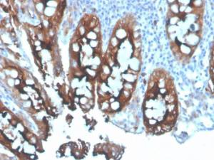 Immunohistochemical analysis of formalin-fixed, paraffin-embedded human colon carcinoma using Anti-Carcinoembryonic Antigen Antibody