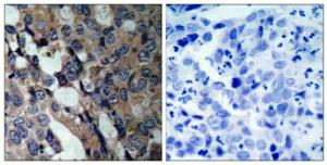 Immunohistochemical analysis of paraffin-embedded human breast carcinoma tissue using Anti-HSP27 Antibody. The right hand panel represents a negative control, where the antibody was pre-incubated with the immunising peptide.