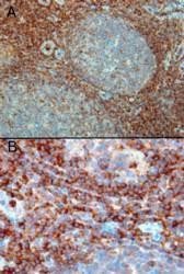 Anti-RAC2 Antibody (A83810) (0.3 µg/ml) staining of paraffin embedded Human Tonsil. Microwaved antigen retrieval with Tris/EDTA buffer pH9, HRP-staining. A) Strong staining in the interfollicular area and mantle zone. B) Positive cells in the interfollicular area