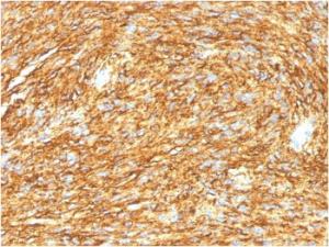 Immunohistochemical analysis of formalin-fixed, paraffin-embedded human GIST using Anti-TMEM16A Antibody [DG1/1485]