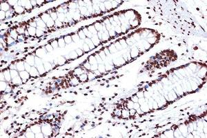 Immunohistochemistry analysis of paraffin-embedded human colon tissue using Anti-FUBP1 / FBP Antibody [ARC1403] (A309248) at a dilution of 1:100 (40x lens). Perform microwave antigen retrieval with 10 mM Tris/EDTA buffer pH 9.0 before commencing with IHC staining protocol.