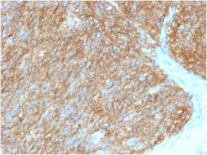 Immunohistochemical analysis of formalin-fixed, paraffin-embedded human GIST using Anti-TMEM16A Antibody [DG1/1486]