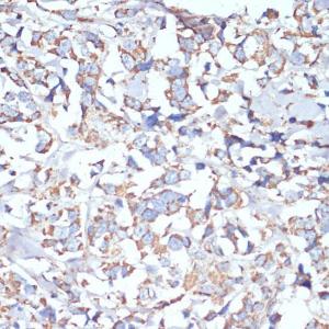 Immunohistochemistry analysis of paraffin-embedded human breast cancer tissue using Anti-COX5A Antibody (A9867) at a dilution of 1:100 (40X lens). Perform microwave antigen retrieval with 10 mM PBS buffer pH 7.2 before commencing with IHC staining protocol