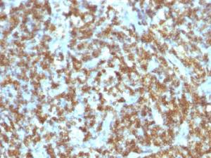 Immunohistochemical analysis of formalin-fixed, paraffin-embedded human lymphoma using Anti-CD45RO Antibody [SPM125]