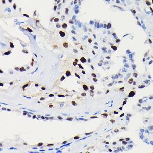 Immunohistochemistry analysis of paraffin-embedded human thyroid cancer using Anti-Cyclin D1 Antibody [ARC0300] (A306339) at a dilution of 1:100 (40X lens). Perform high pressure antigen retrieval with 10 mM citrate buffer pH 6.0 before commencing with IHC staining protocol