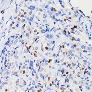 Immunohistochemistry analysis of paraffin-embedded human breast cancer tissue using Anti-Cyclin D1 Antibody [ARC0300] (A306339) at a dilution of 1:100 (40X lens). Perform high pressure antigen retrieval with 10 mM citrate buffer pH 6.0 before commencing with IHC staining protocol