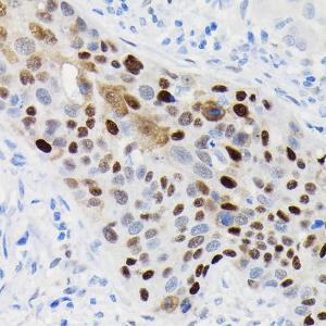 Immunohistochemistry analysis of paraffin-embedded human esophageal cancer using Anti-Cyclin D1 Antibody [ARC0300] (A306339) at a dilution of 1:100 (40X lens). Perform high pressure antigen retrieval with 10 mM citrate buffer pH 6.0 before commencing with IHC staining protocol