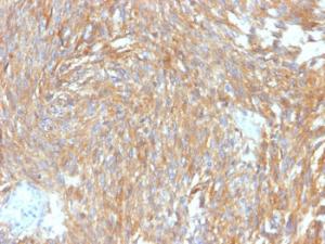 Immunohistochemical analysis of formalin-fixed, paraffin-embedded human GIST using Anti-TMEM16A Antibody [DG1/2564R]