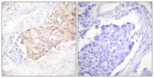 Immunohistochemical analysis of paraffin-embedded human breast carcinoma tissue using Anti-EDD Antibody. The right hand panel represents a negative control, where the antibody was pre-incubated with the immunising peptide.