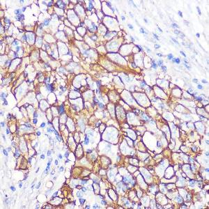 Immunohistochemistry analysis of paraffin-embedded human esophageal cancer using Anti-NDRG1 Antibody [ARC0887] (A306340) at a dilution of 1:100 (40X lens). Perform microwave antigen retrieval with 10 mM PBS buffer pH 7.2 before commencing with IHC staining protocol