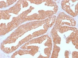 Immunohistochemical analysis of formalin-fixed, paraffin-embedded human prostate carcinoma using Anti-Calcineurin A Antibody [CALNA/2353]