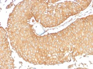 Immunohistochemical analysis of formalin-fixed, paraffin-embedded human ovarian carcinoma using Anti-Calcineurin A Antibody [CALNA/2353]