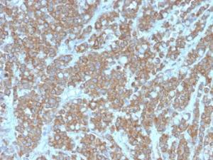 Immunohistochemical analysis of formalin-fixed, paraffin-embedded human colon carcinoma using Anti-IL-1 alpha Antibody [IL1A/3981]