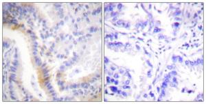 Immunohistochemical analysis of paraffin-embedded human lung carcinoma tissue using Anti-Urocortin Antibody. The right hand panel represents a negative control, where the antibody was pre-incubated with the immunising peptide