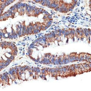 Immunohistochemistry analysis of paraffin-embedded human colon carcinoma tissue using Anti-PAR4 Antibody [ARC1980] (A309260) at a dilution of 1:100 (40x lens). Perform microwave antigen retrieval with 10 mM Tris/EDTA buffer pH 9.0 before commencing with IHC staining protocol.