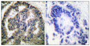 Immunohistochemical analysis of paraffin-embedded human lung carcinoma tissue using Anti-TGF beta2 Antibody. The right hand panel represents a negative control, where the antibody was pre-incubated with the immunising peptide.