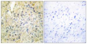 Immunohistochemical analysis of paraffin-embedded human prostate carcinoma tissue using Anti-DLEC1 Antibody. The right hand panel represents a negative control, where the antibody was pre-incubated with the immunising peptide