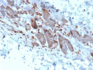 Immunohistochemical analysis of formalin-fixed, paraffin-embedded human colon carcinoma using Anti-IL-1 alpha Antibody [IL1A/3982]