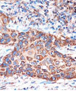 Immunohistochemistry analysis of paraffin-embedded human lung cancer using Anti-HIBADH Antibody (A305430) at a dilution of 1:100 (40x lens). Perform microwave antigen retrieval with 10 mM PBS buffer pH 7.2 before commencing with IHC staining protocol.