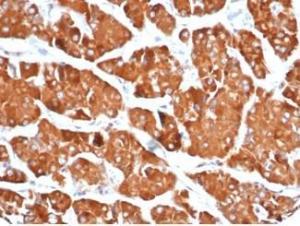 Immunohistochemical analysis of formalin-fixed, paraffin-embedded human renal oncocytoma using Anti-DBC2 Antibody [DBC2/3361] at 2 µg/ml in PBS for 30 minutes at room temperature