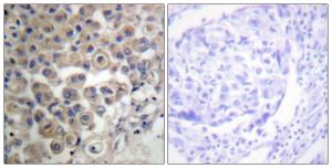 Immunohistochemical analysis of paraffin-embedded human breast carcinoma tissue using Anti-PLC beta3 Antibody. The right hand panel represents a negative control, where the antibody was pre-incubated with the immunising peptide