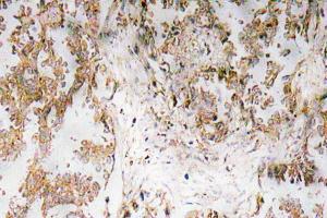 Immunohistochemical analysis of paraffin-embedded human lung carcinoma tissue using Anti-IL-1alpha Antibody