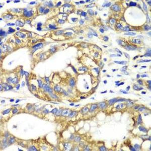 Immunohistochemistry analysis of paraffin-embedded human gastric cancer using Anti-AK2 Antibody (A9900) at a dilution of 1:100 (40X lens). Perform microwave antigen retrieval with 10 mM PBS buffer pH 7.2 before commencing with IHC staining protocol