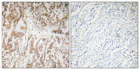 Immunohistochemical analysis of paraffin-embedded human lung cancer using Anti-IL-1alpha Antibody 1:100 (4°C overnight). The right hand panel represents a negative control, where the antibody was pre-incubated with the immunising peptide.