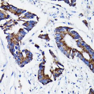 Immunohistochemistry analysis of paraffin-embedded human colon carcinoma tissue using Anti-Prohibitin Antibody [ARC0007] (A305437) at a dilution of 1:100 (40x lens)